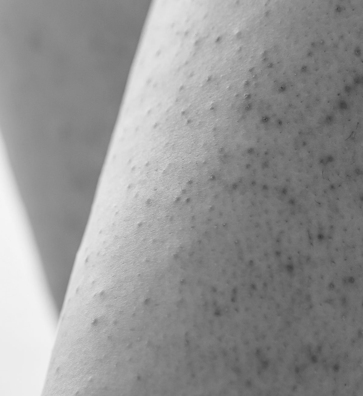 Keratosis Pilaris